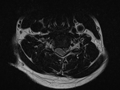 výhřez meziobratlové plotýnky krční páteře zobrazený na MRI