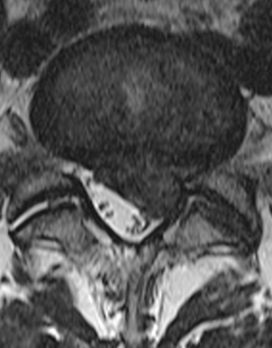 SM systém Levostranný výhřez ploténky_MRI_bolesti dolní části zad