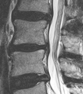Spirální stabilizace - ano nebo ne. MRI bederní páteře z boku