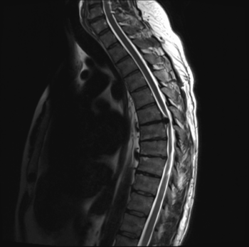 bolest zad, výhřez meziobratlové ploténky hrudní páteře_MRI
